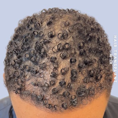 Hair Restoration Before & After Gallery - Patient 231131 - Image 2