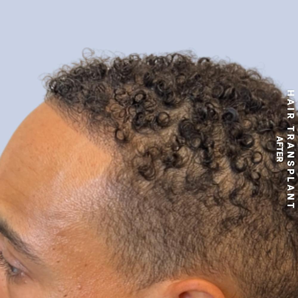 Hair Restoration Before & After Gallery - Patient 231131 - Image 8