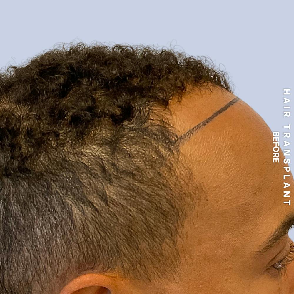 Hair Restoration Before & After Gallery - Patient 231131 - Image 3