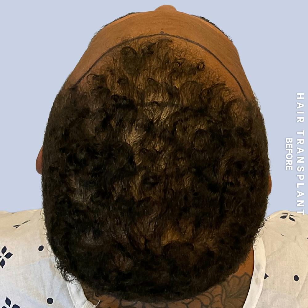 Hair Restoration Before & After Gallery - Patient 231131 - Image 5