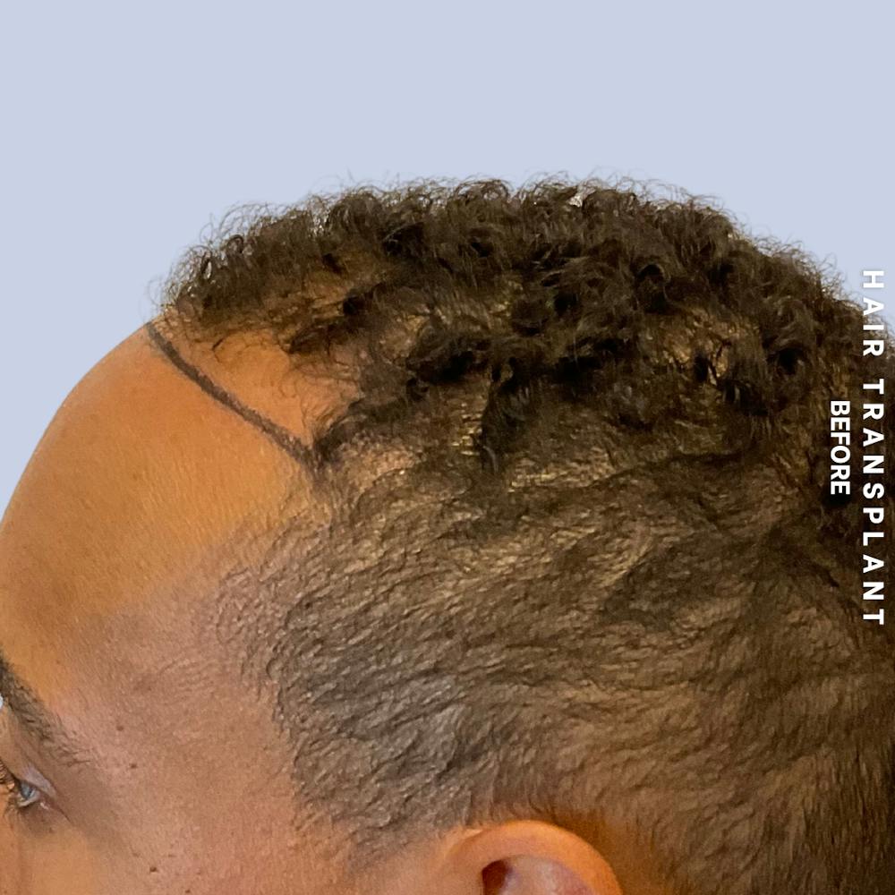 Hair Restoration Before & After Gallery - Patient 231131 - Image 7
