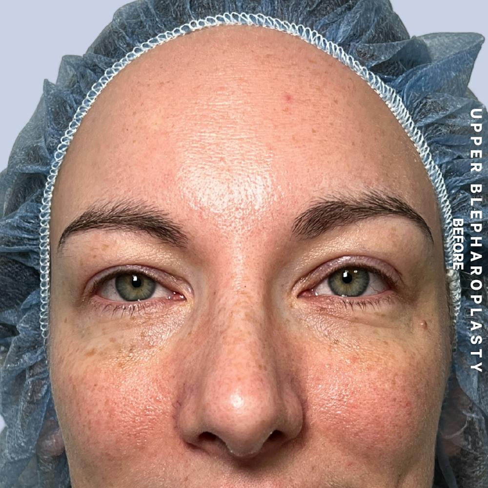 Eyes Before & After Gallery - Patient 117534 - Image 1