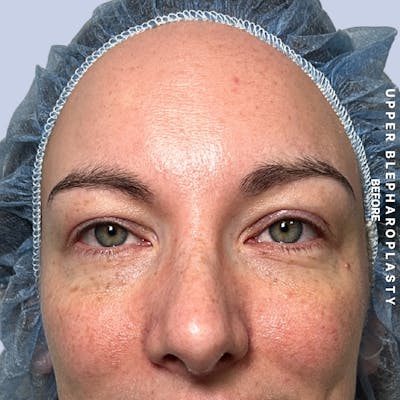 Eyes Before & After Gallery - Patient 117534 - Image 1