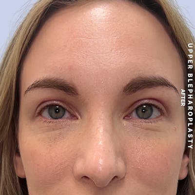 Eyes Before & After Gallery - Patient 117534 - Image 2