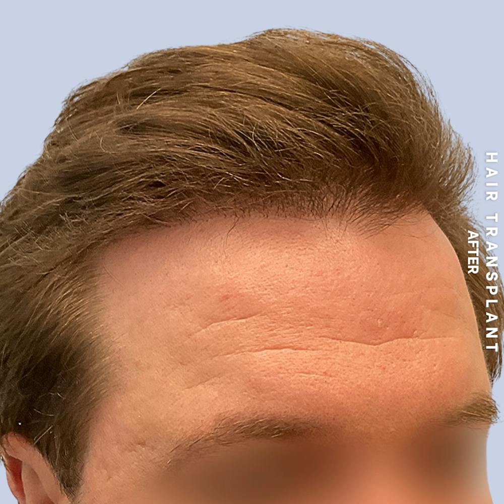 Men's Hair Before & After Gallery - Patient 387489 - Image 4