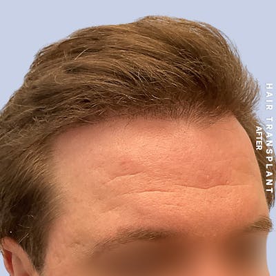 Men's Hair Before & After Gallery - Patient 387489 - Image 4