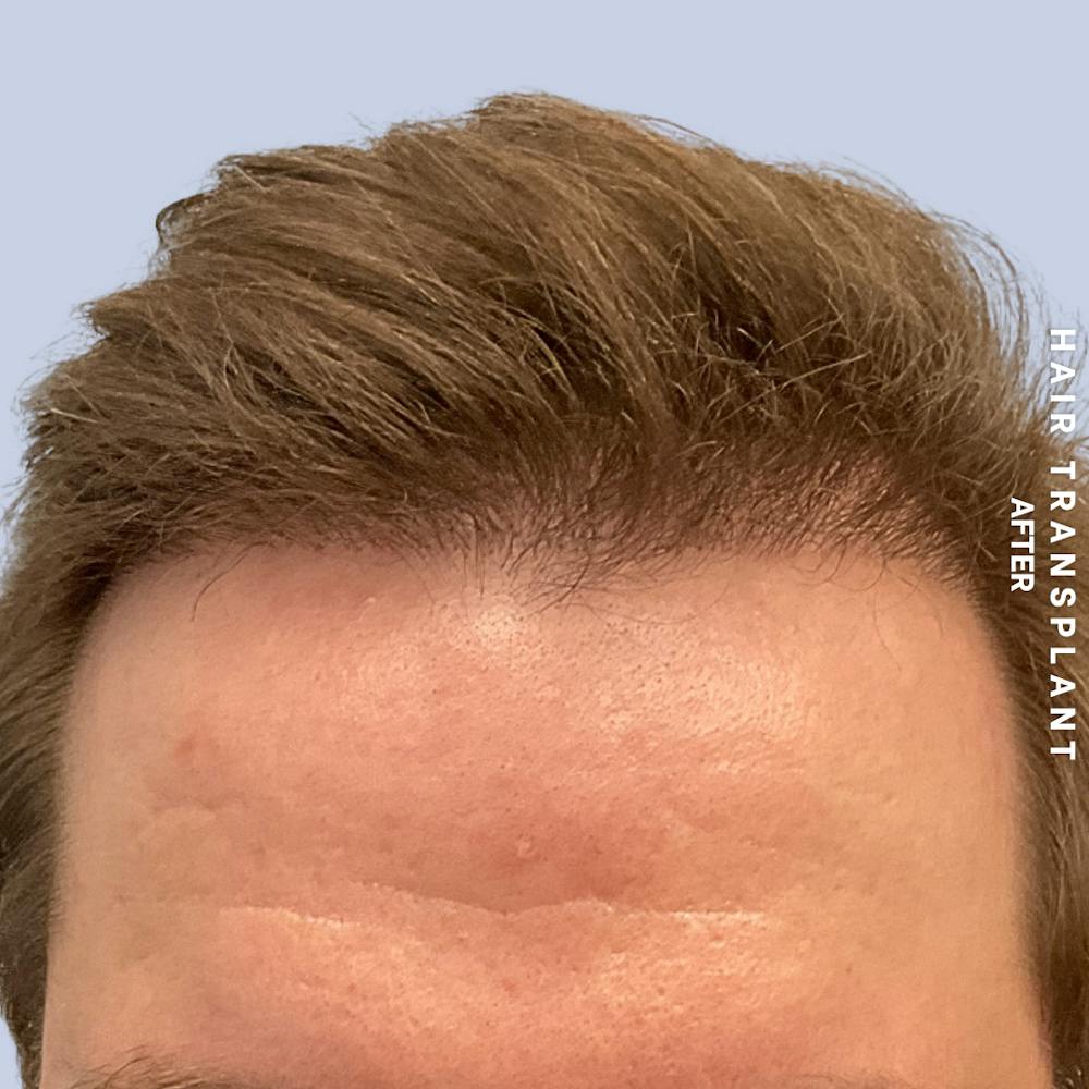 Men's Hair Before & After Gallery - Patient 387489 - Image 2