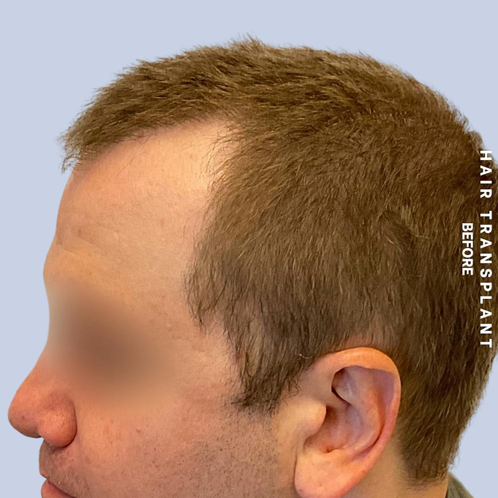 Men's Hair Before & After Gallery - Patient 387489 - Image 5