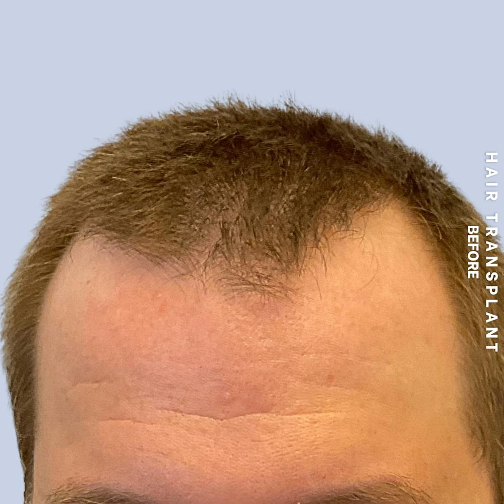 Men's Hair Before & After Gallery - Patient 387489 - Image 1