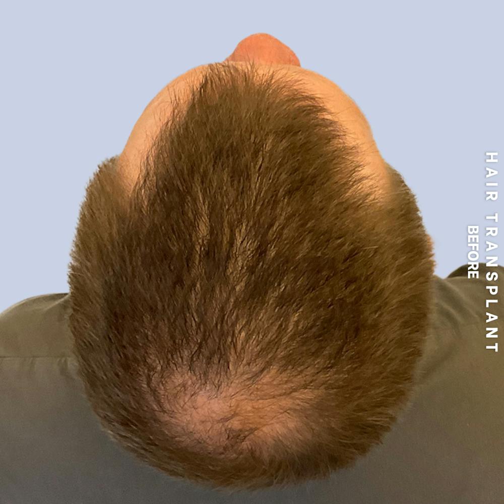Men's Hair Before & After Gallery - Patient 387489 - Image 7