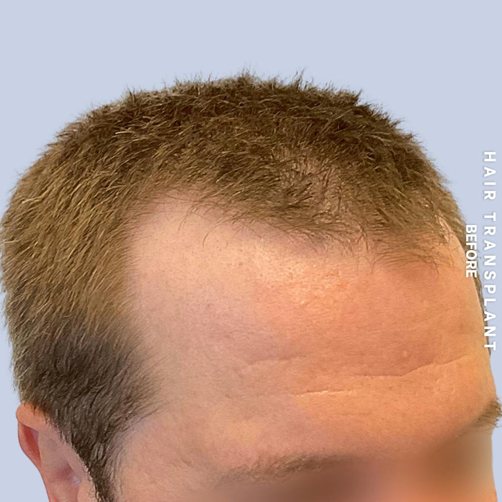 Men's Hair Before & After Gallery - Patient 387489 - Image 3