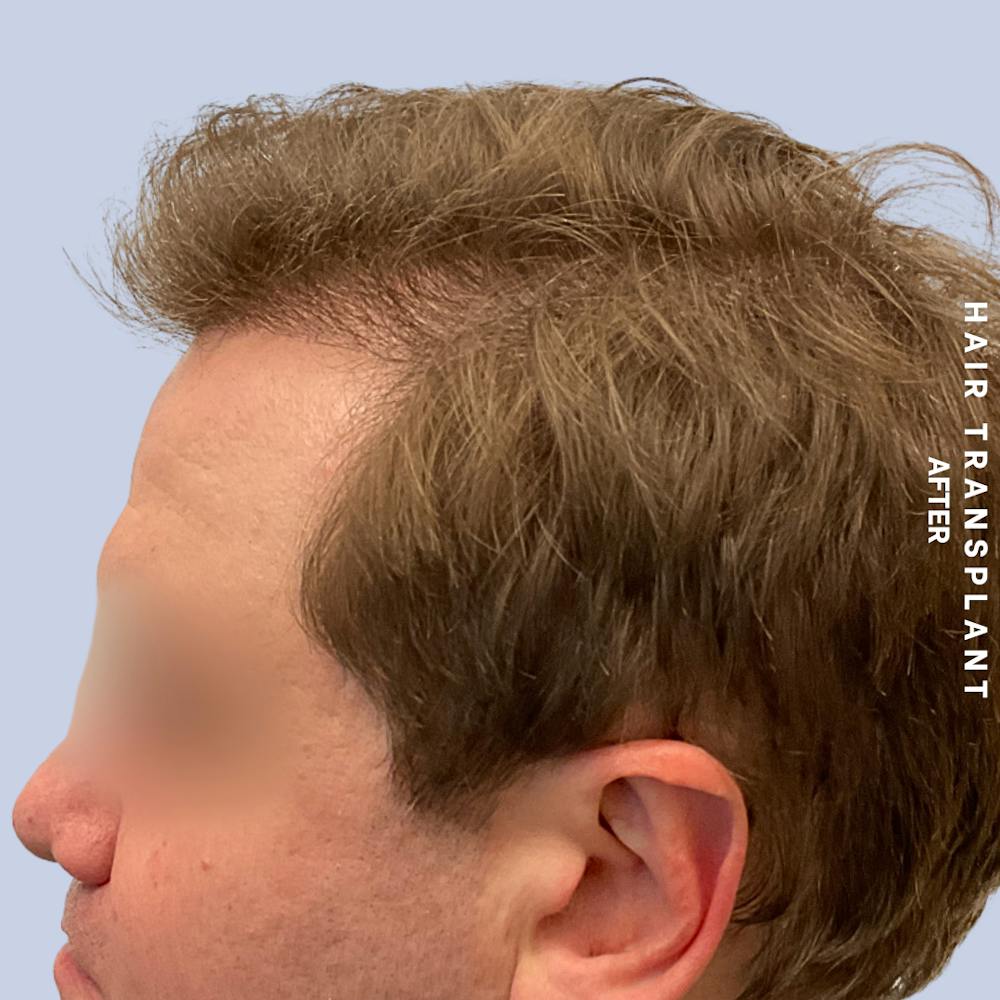Men's Hair Before & After Gallery - Patient 387489 - Image 6