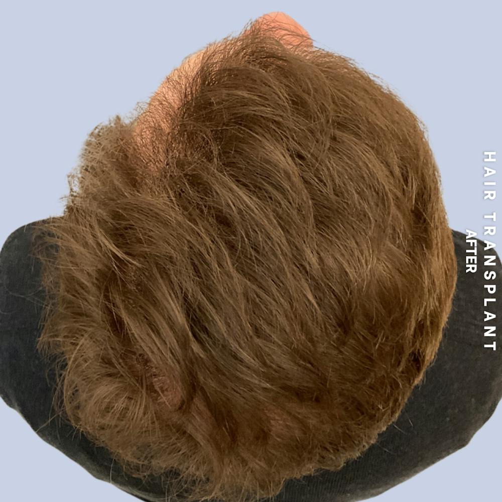 Men's Hair Before & After Gallery - Patient 387489 - Image 8
