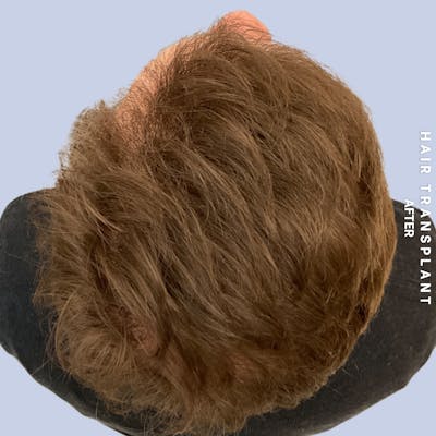 Men's Hair Before & After Gallery - Patient 387489 - Image 8