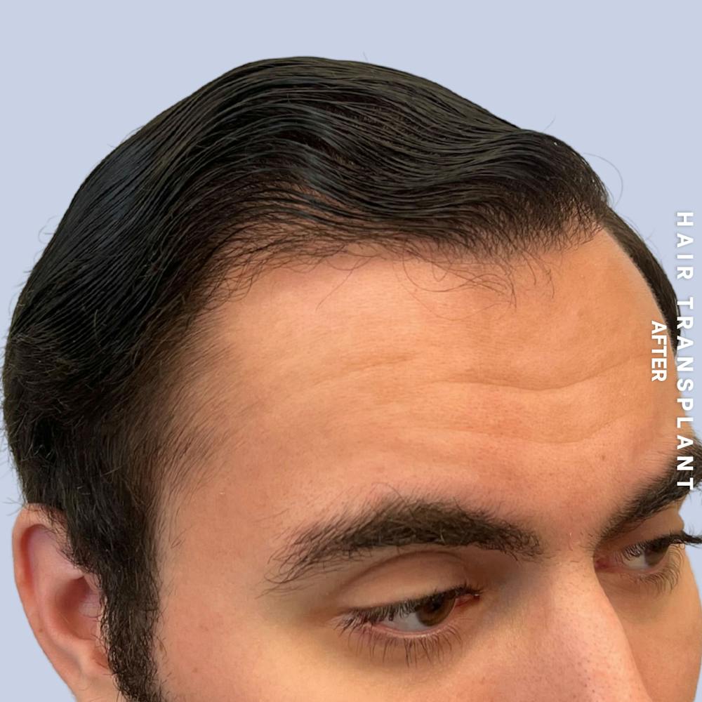 Men's Hair Before & After Gallery - Patient 339357 - Image 4