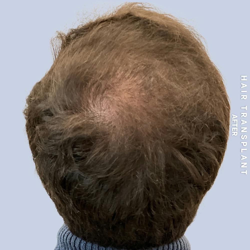 Men's Hair Before & After Gallery - Patient 339357 - Image 6
