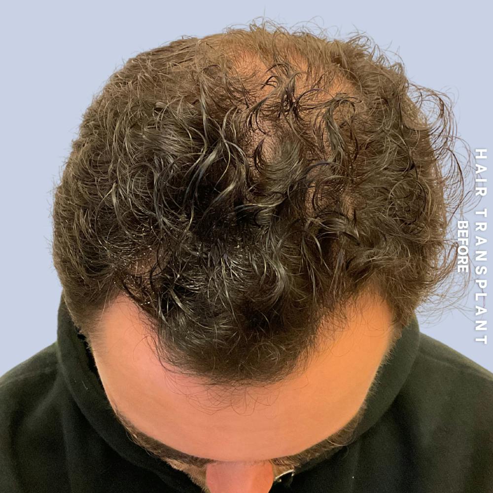 Men's Hair Before & After Gallery - Patient 339357 - Image 1