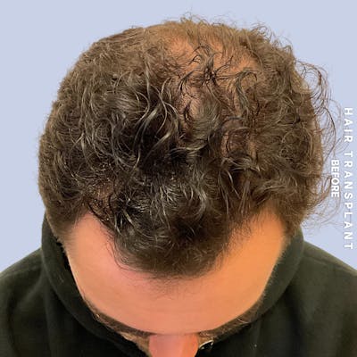 Hair Restoration Before & After Gallery - Patient 199792 - Image 1