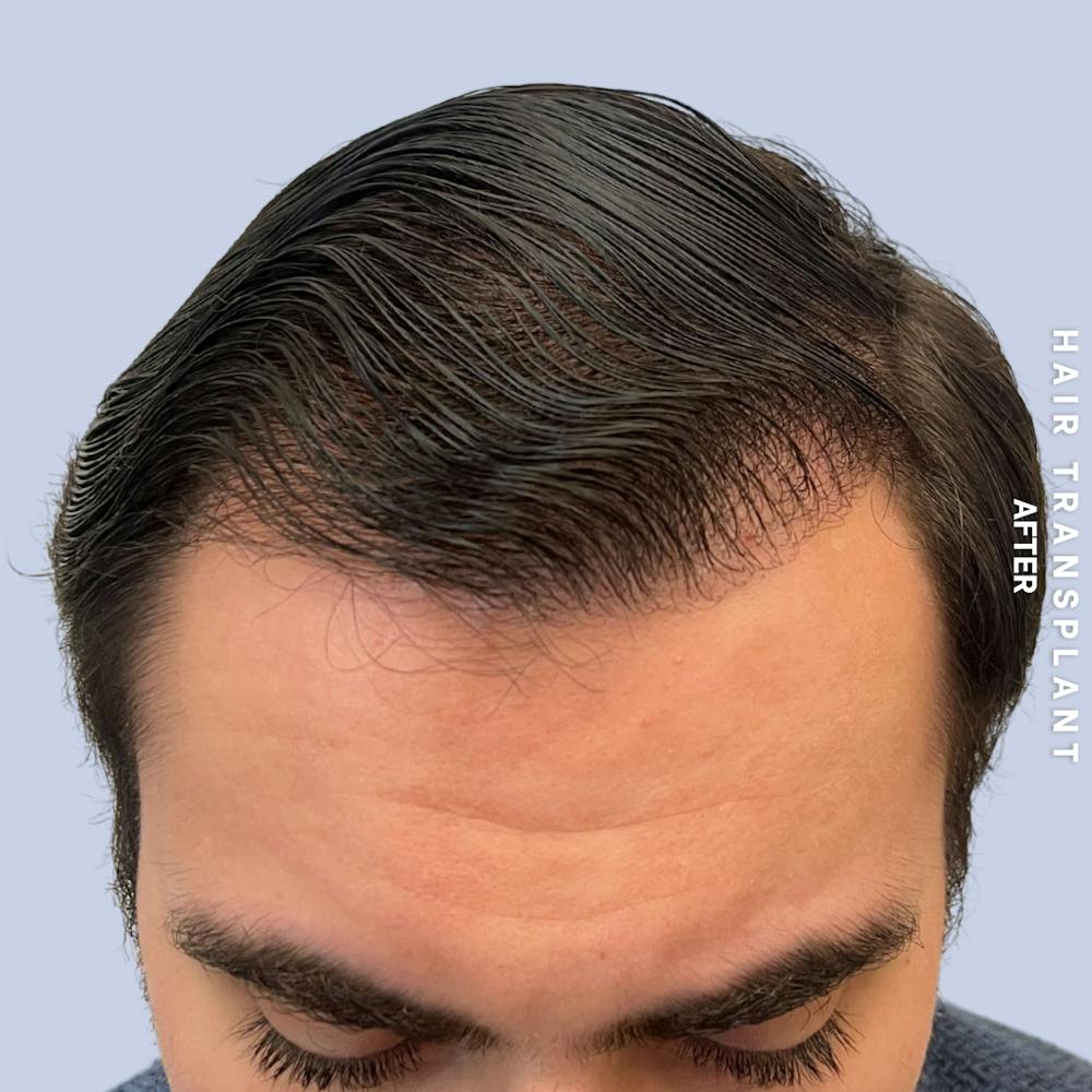 Men's Hair Before & After Gallery - Patient 339357 - Image 2