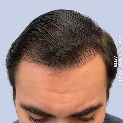 Men's Hair Before & After Gallery - Patient 339357 - Image 2