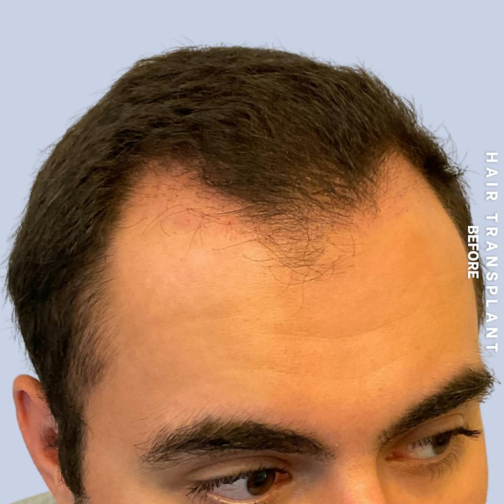 Men's Hair Before & After Gallery - Patient 339357 - Image 3
