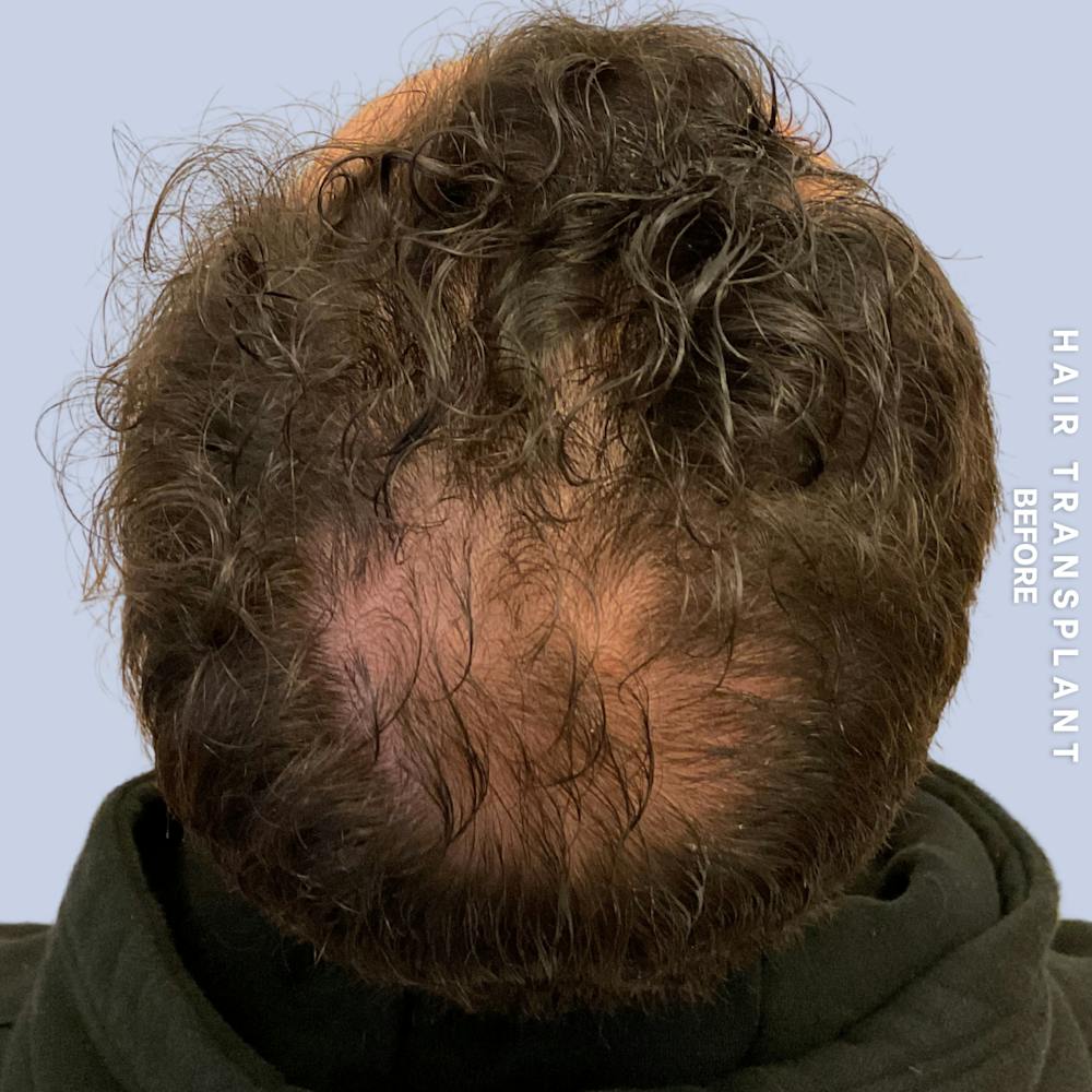 Men's Hair Before & After Gallery - Patient 339357 - Image 5