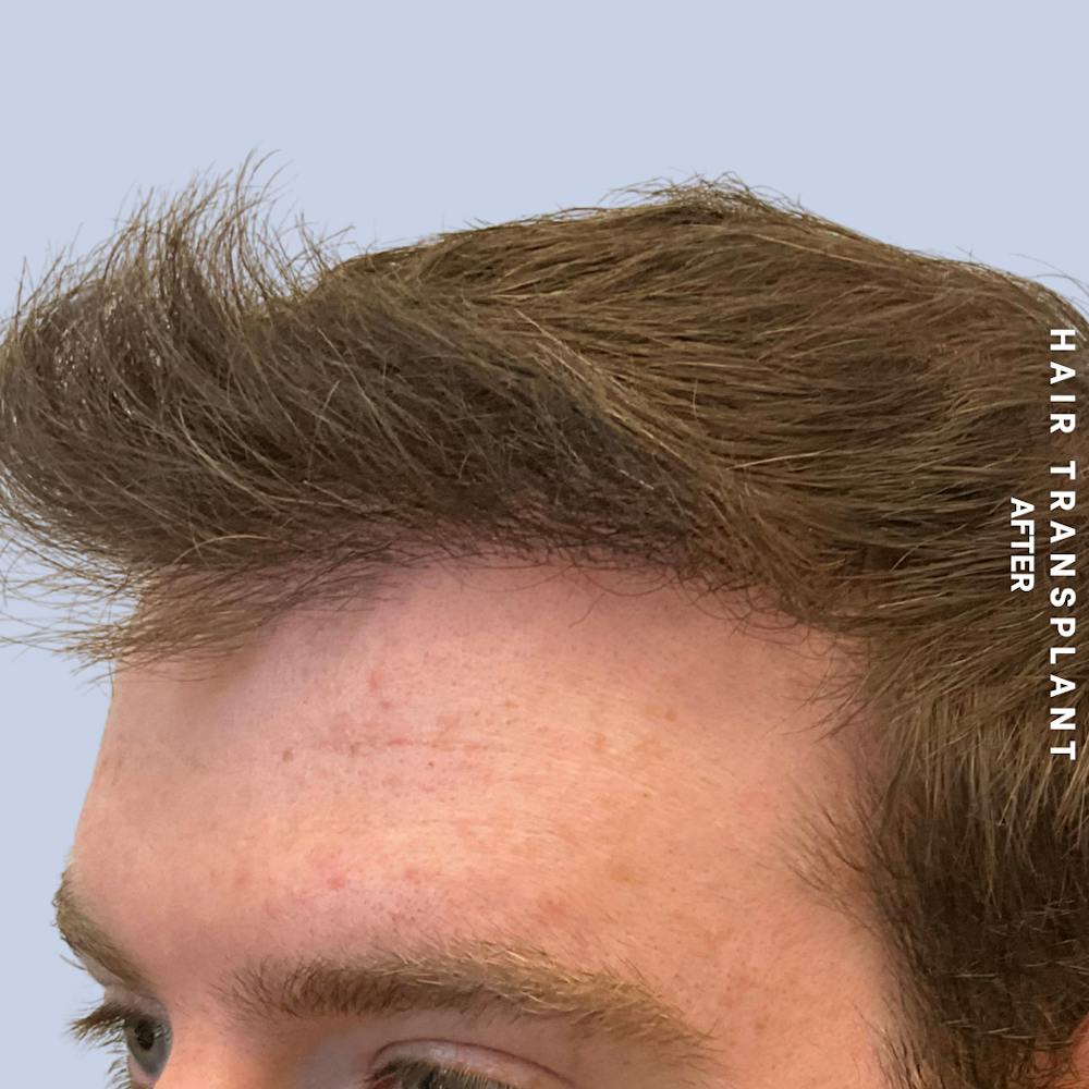 Hair Restoration Before & After Gallery - Patient 120156 - Image 4