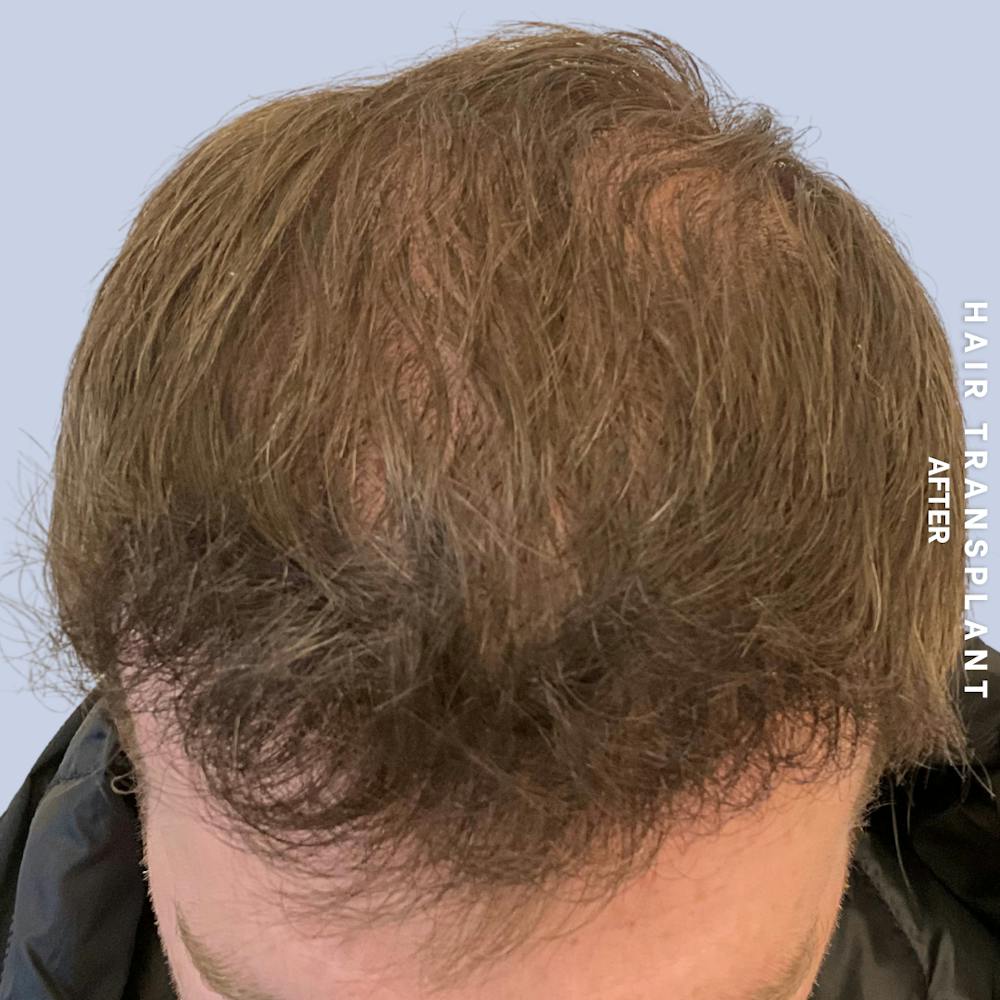Hair Restoration Before & After Gallery - Patient 120156 - Image 6