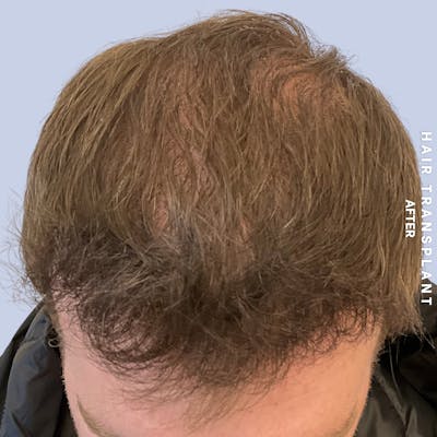 Hair Restoration Before & After Gallery - Patient 120156 - Image 6
