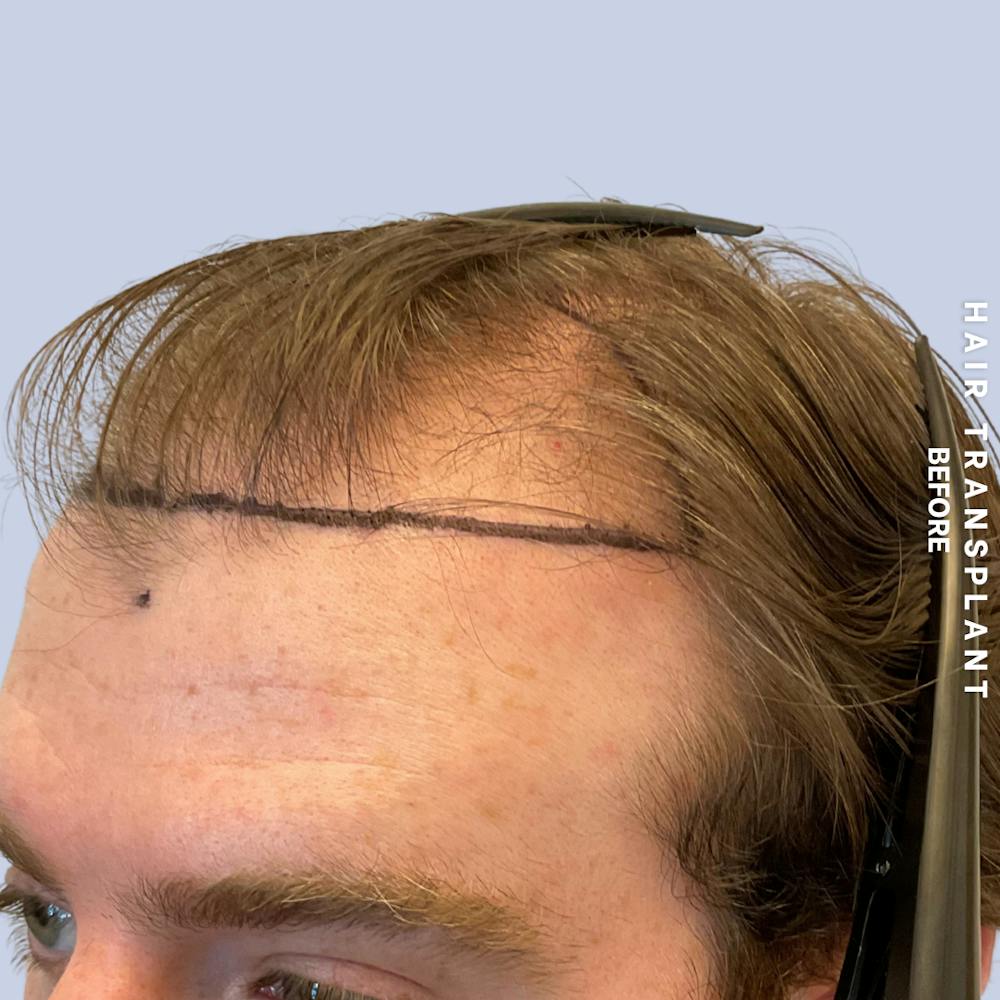 Hair Restoration Before & After Gallery - Patient 120156 - Image 3