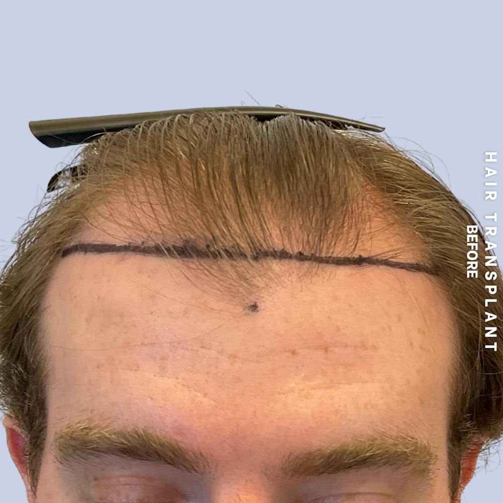 Hair Restoration Before & After Gallery - Patient 120156 - Image 1