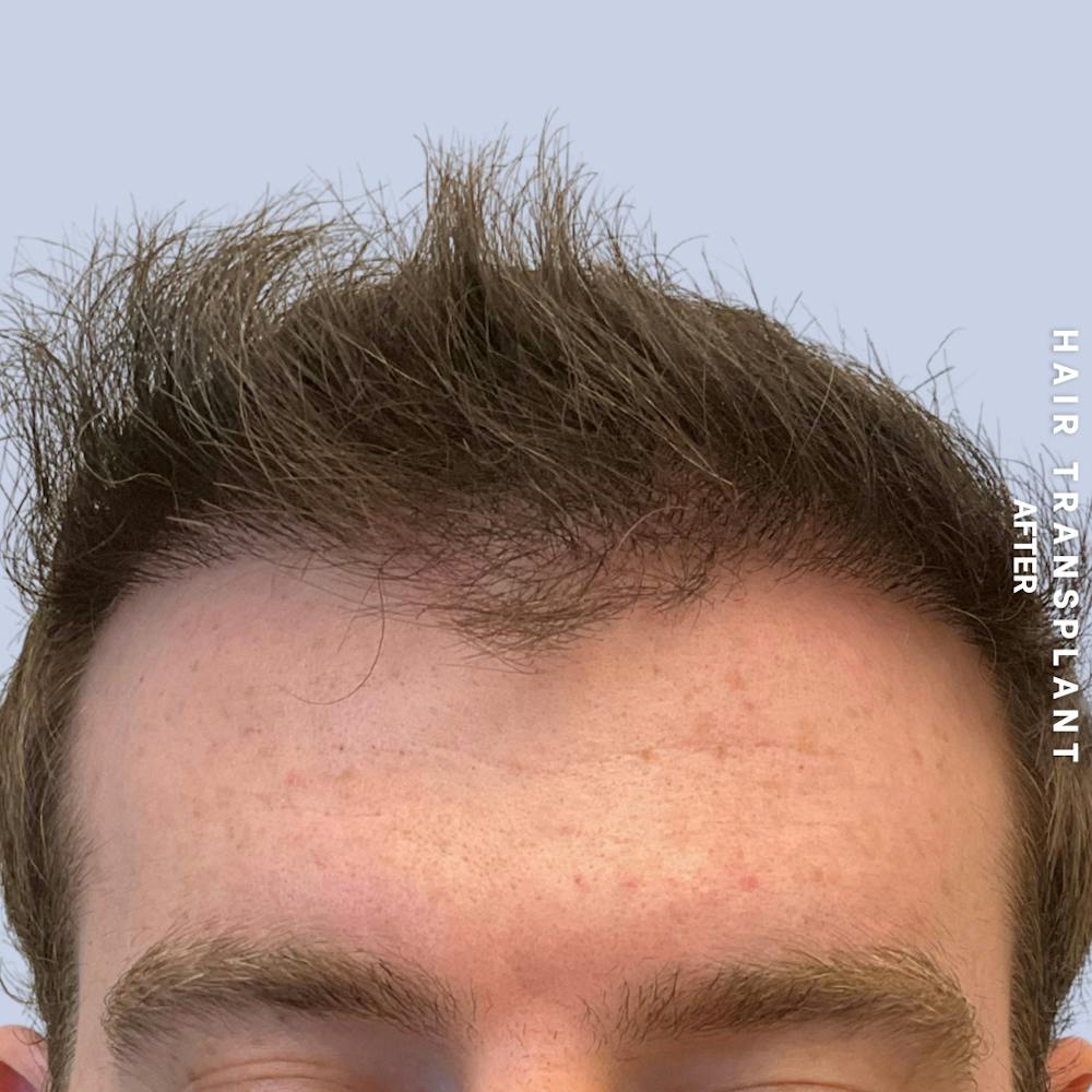 Hair Restoration Before & After Gallery - Patient 120156 - Image 2