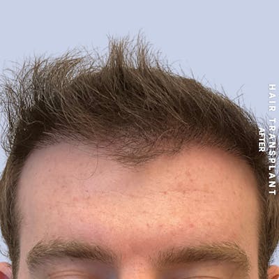 Hair Restoration Before & After Gallery - Patient 120156 - Image 2