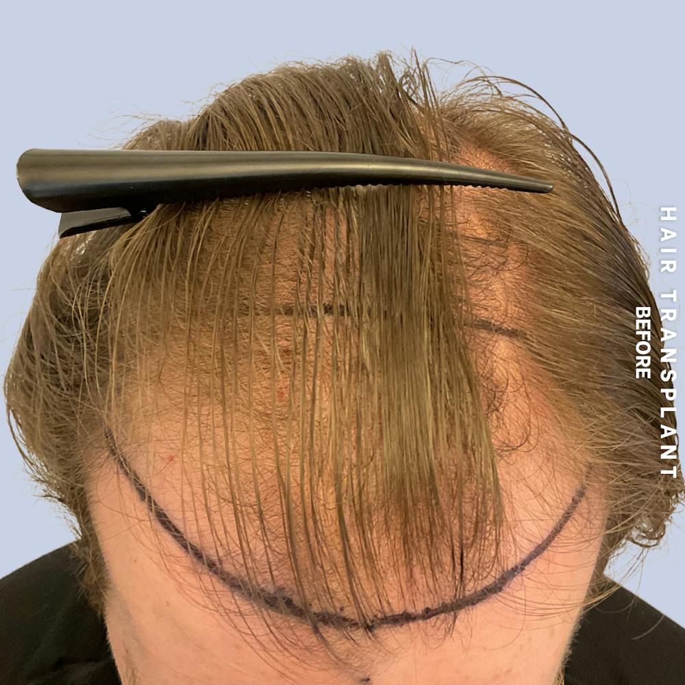 Hair Restoration Before & After Gallery - Patient 120156 - Image 5