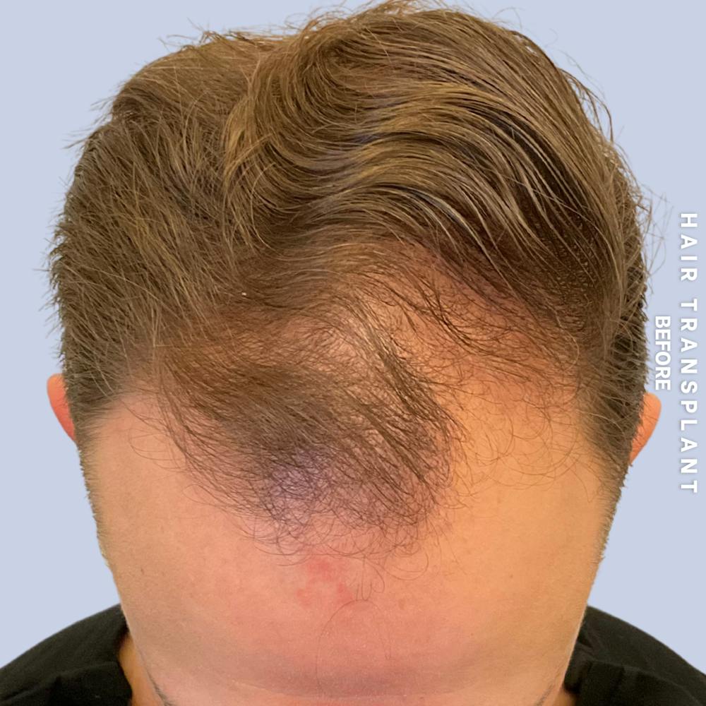 Men's Hair Before & After Gallery - Patient 192513 - Image 1