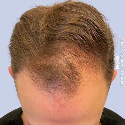 Hair Restoration Before & After Gallery - Patient 164128 - Image 1