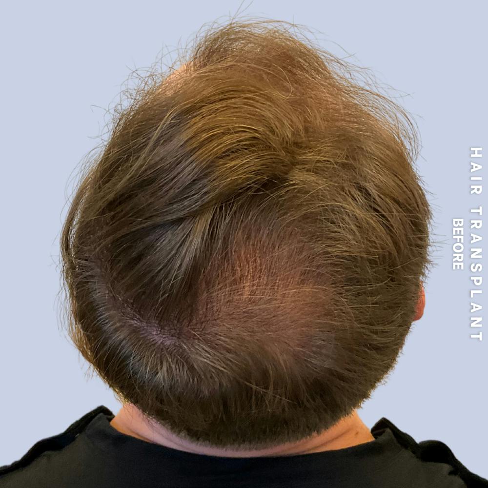 Men's Hair Before & After Gallery - Patient 192513 - Image 3