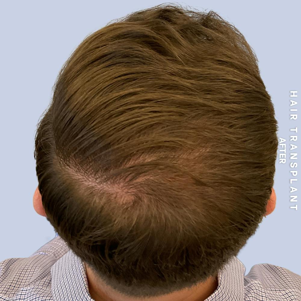 Men's Hair Before & After Gallery - Patient 192513 - Image 4