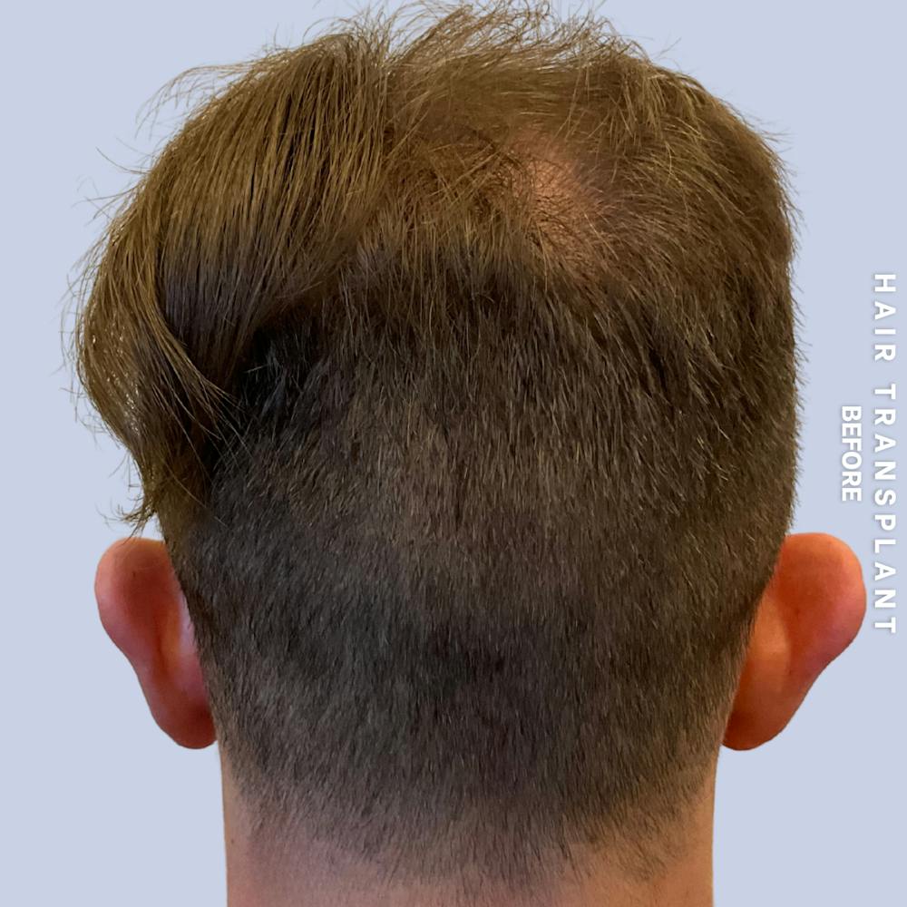 Men's Hair Before & After Gallery - Patient 192513 - Image 5