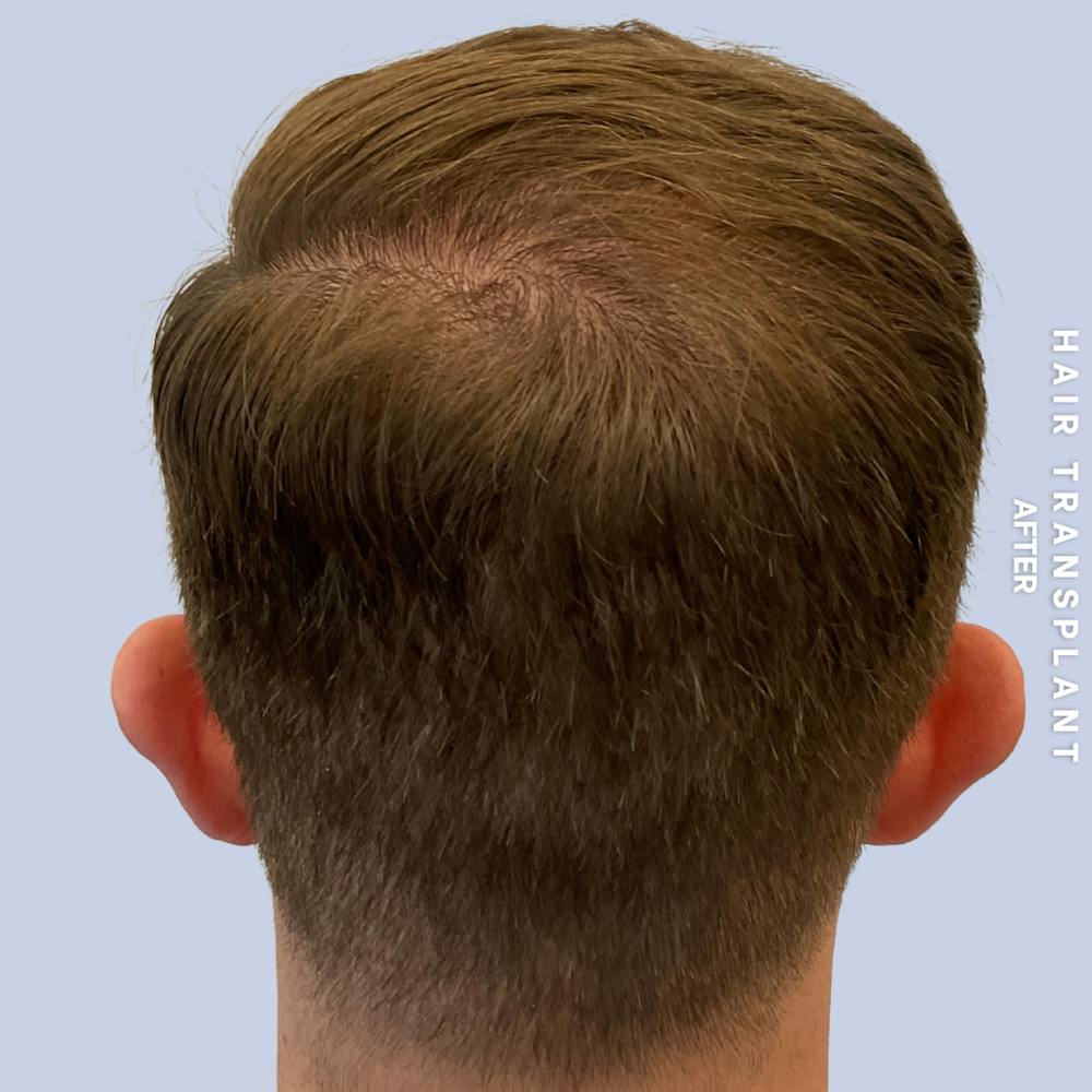 Men's Hair Before & After Gallery - Patient 192513 - Image 6