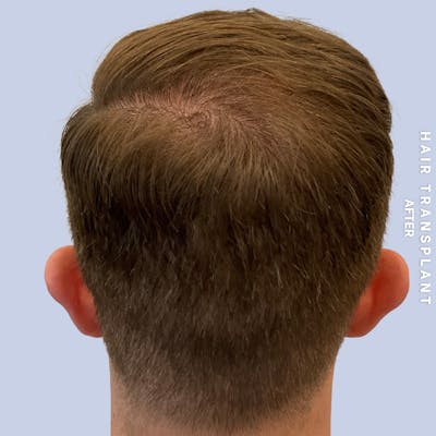 Men's Hair Before & After Gallery - Patient 192513 - Image 6