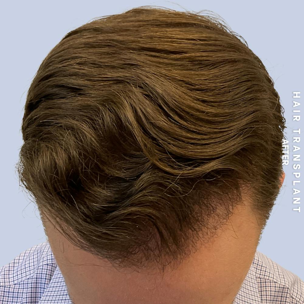 Men's Hair Before & After Gallery - Patient 192513 - Image 2