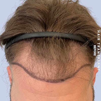 Hair Restoration Before & After Gallery - Patient 233466 - Image 1