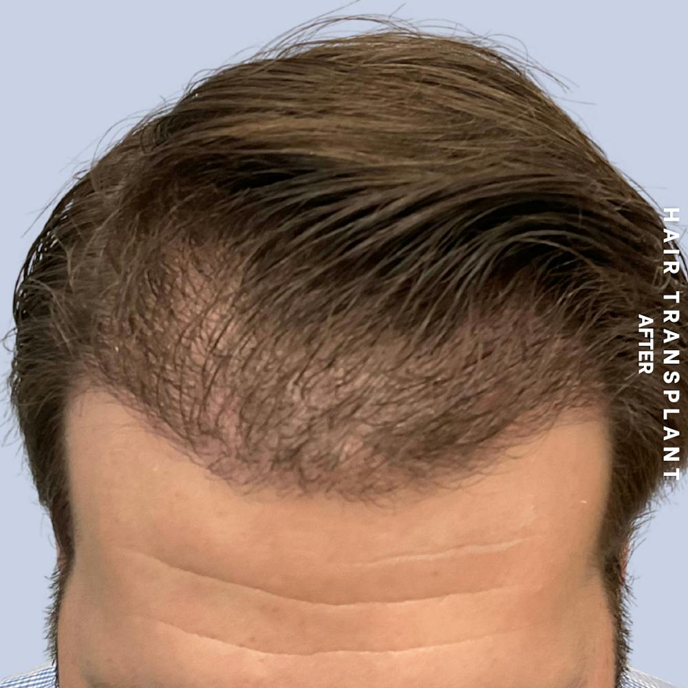 Men's Hair Before & After Gallery - Patient 125197 - Image 2
