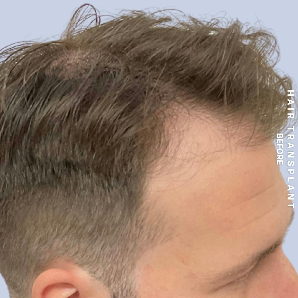 Men's Hair Before & After Gallery - Patient 125197 - Image 3