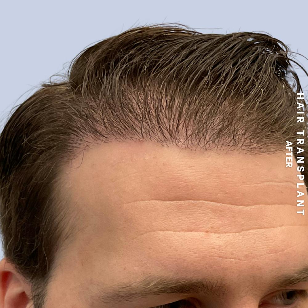 Men's Hair Before & After Gallery - Patient 125197 - Image 4