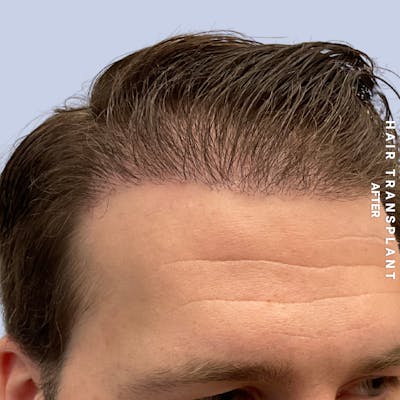 Men's Hair Before & After Gallery - Patient 125197 - Image 4
