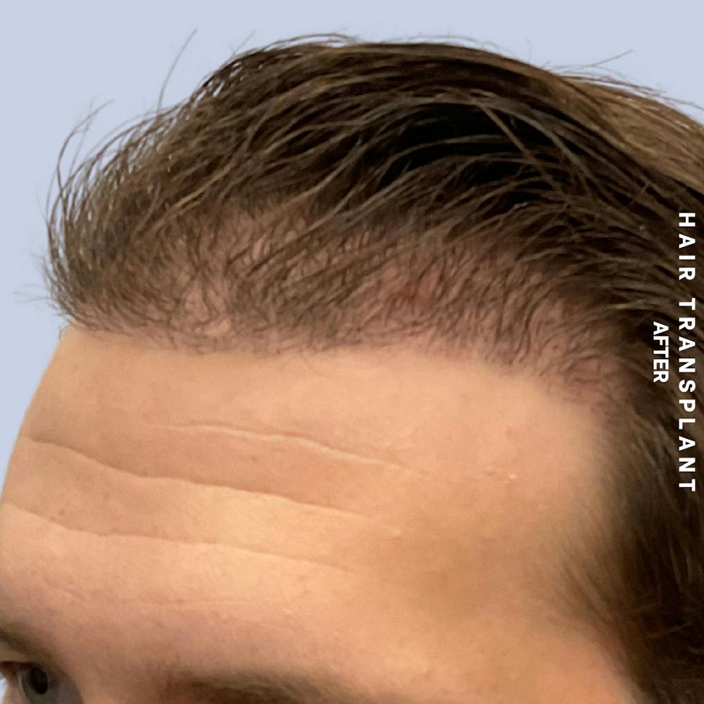 Men's Hair Before & After Gallery - Patient 125197 - Image 6