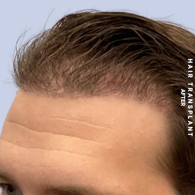 Men's Hair Before & After Gallery - Patient 125197 - Image 6
