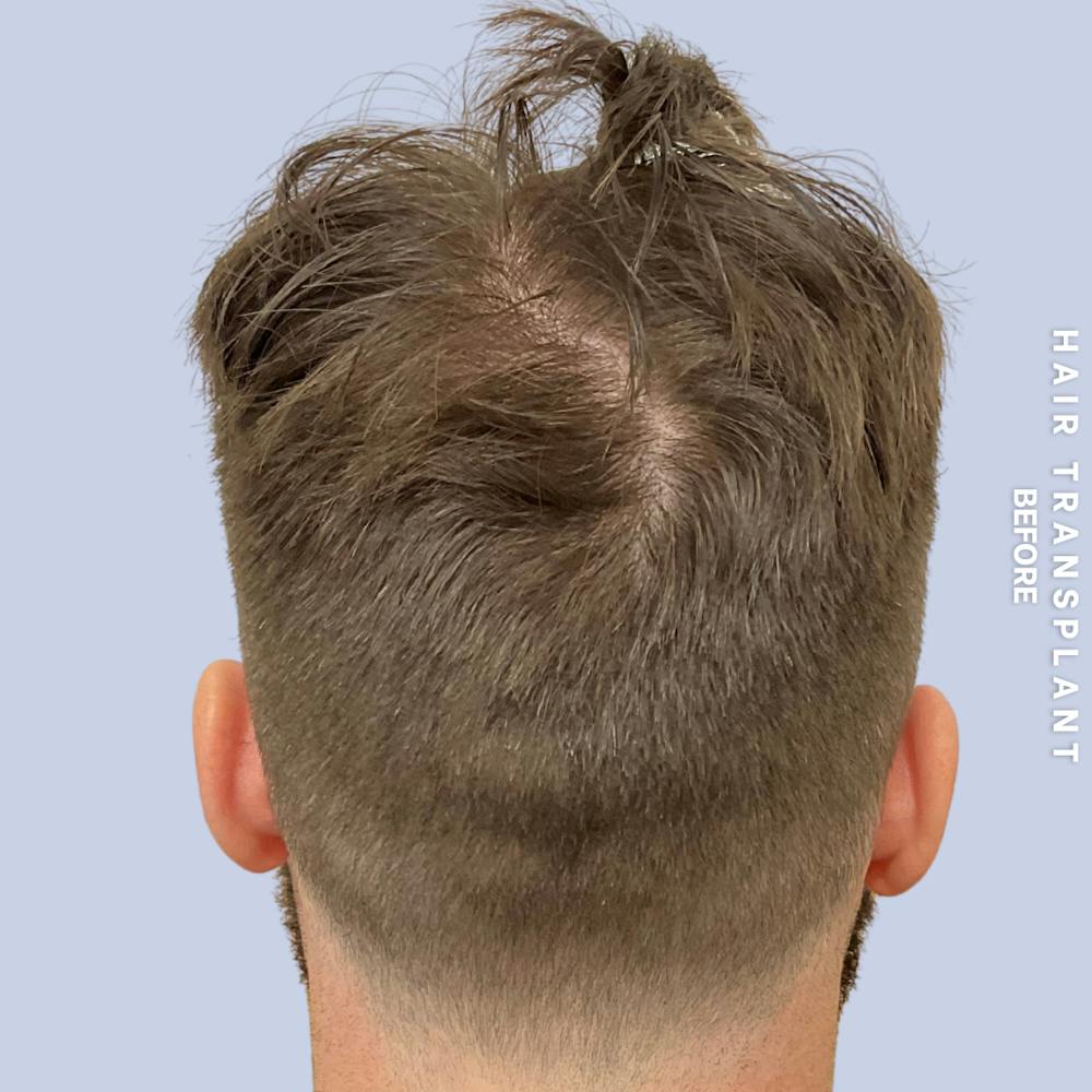 Men's Hair Before & After Gallery - Patient 125197 - Image 7